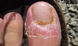 Leczenie grzyba paznokci