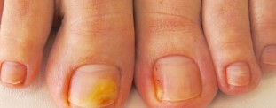 Podstawowe objawy i zdjęcia grzybicy paznokci