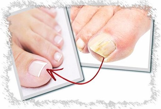 sposoby leczenia grzybicy paznokci stóp