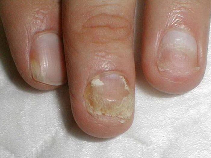 Leczenie grzybicy paznokci Candida