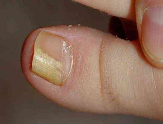 dystalna boczna postać grzyba paznokci