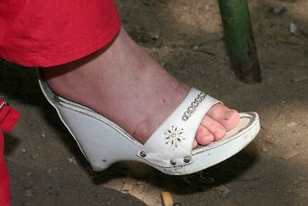 Brak odpowiedniej higieny stóp jest przyczyną rozwoju grzyba