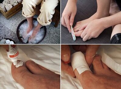 Gotowanie na parze stóp i nakładanie kremu mocznikowego na zaatakowane przez grzyby paznokcie
