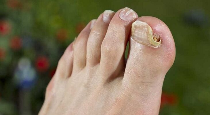 uszkodzenie płytki paznokcia grzybem na nogach