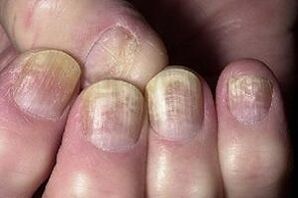 zmiana paznokcia z infekcją grzybiczą