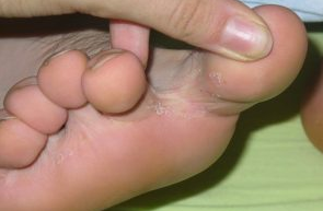 Grzybica między palcami u nóg