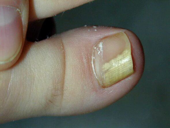 grzybicze zakażenie paznokci