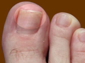 Grzybica paznokci – wskazanie do stosowania kropli grzybobójczych