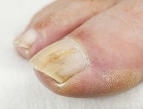 W przypadku ropienia w pobliżu paznokcia nie można stosować kropli przeciwgrzybiczych