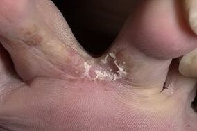 grzybica skóry między palcami