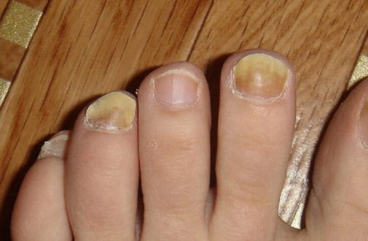objawy grzybicy paznokci i skóry stóp