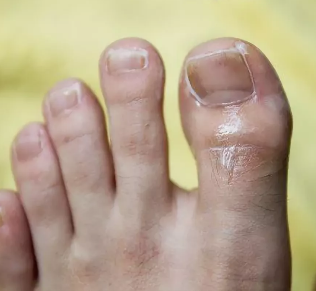 Grzybica paznokcia na dużym palcu