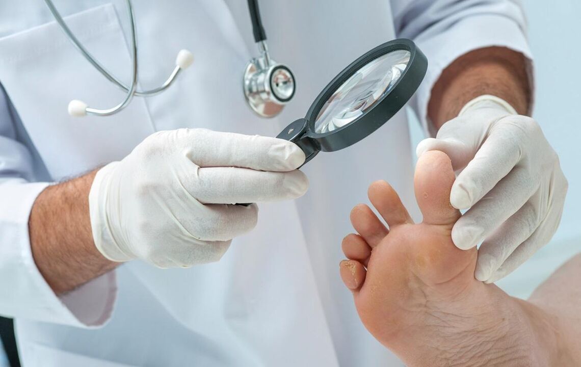 lekarz bada stopy z grzybicą