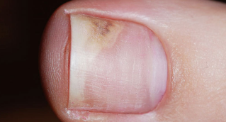 Objawy początkowego stadium grzybicy paznokci
