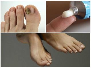 grzybica paznokci na nogach leczenie