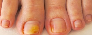 grzybica paznokci na nogach objawy