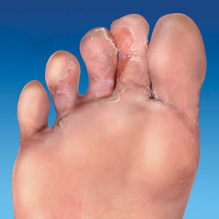 grzybica skóry stóp