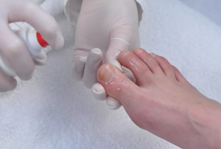 Leczenie uruchomionego grzyba paznokci